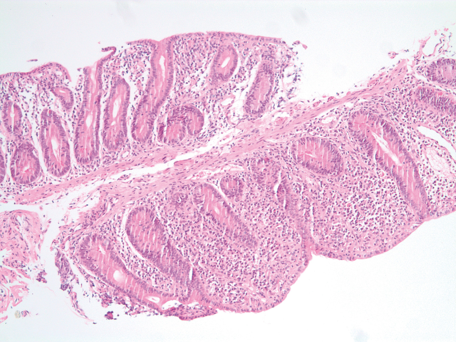 Figur 1 Hematoksylin- og eosinfarget duodenalbiopsi med total totteatrofi, krypthyperplasi og &oslash;kt cellularitet i lamina&hellip;