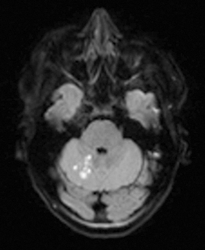 Figur 1 MR av hodet. Diffusjonsvektet sekvens (DWI, diffusion-weighted imaging) avdekker akutte infarktfoci superiort i&hellip;