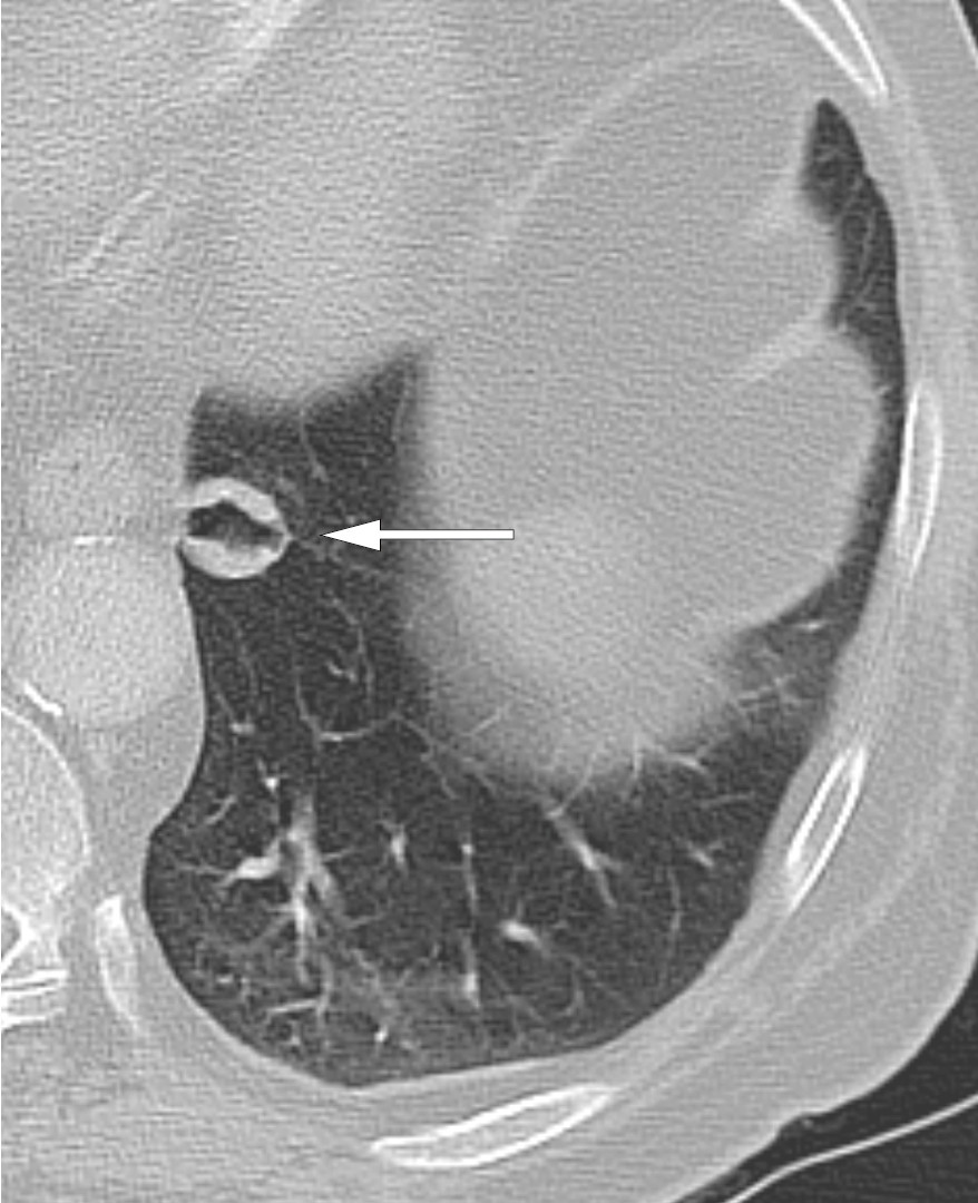 Figur 2 Aksial rekonstruksjon av CT-unders&oslash;kelse med intraven&oslash;s kontrast og lungeemboliprotokoll tatt ved f&oslash;rste innleggelse&hellip;