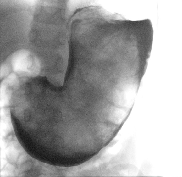 Figur 1 R&oslash;ntgenbildet viser en ikke-veggfast oppfylling (omgitt av kontrast) i magesekken.