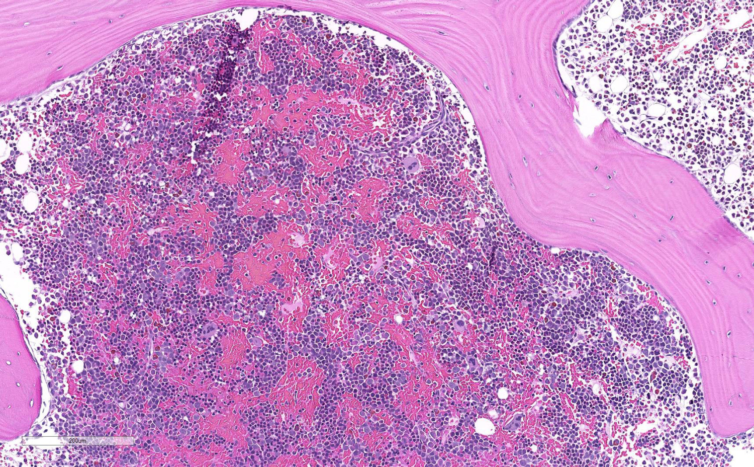 Figur 3 N&aelig;r maksimalt cellerik benmarg hos en pasient med hemolytisk anemi. Her sees sterkt dominerende erytropoese.