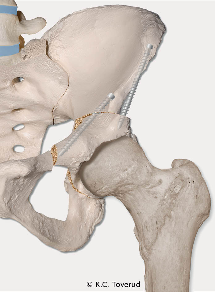 Figur 3 Ved periacetabul&aelig;r osteotomi (PAO) gj&oslash;res osteotomi rundt hele acetabulum slik at denne reorienteres for &aring; gi bedre&hellip;
