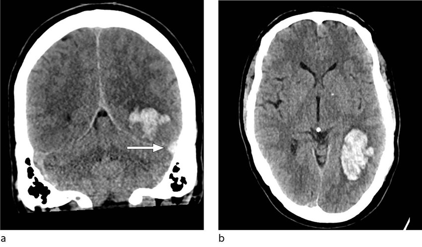 Figur 1 Aksial (a) og coronal (b) CT caput uten intraven&oslash;s kontrast viser intracerebralt hematom i venstre temporallapp med&hellip;