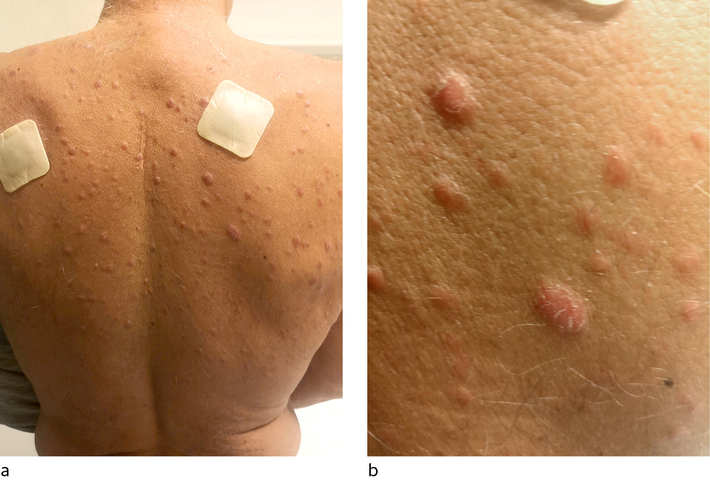 Figur 1 Multiple lyser&oslash;de papler distribuert p&aring; ryggen.