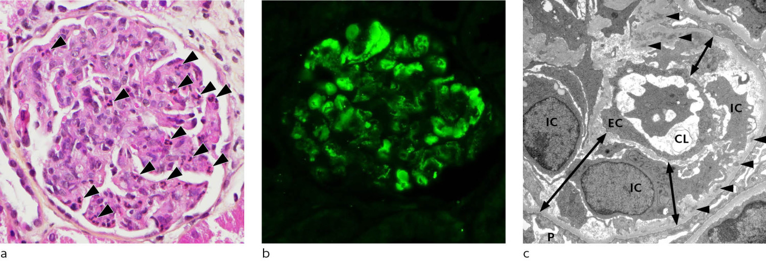Figur 1 (A) Glomerulus med rikelige n&oslash;ytrofile granulocytter (piler) i kapill&aelig;rne; hematoxylin eosin og safran (HES) farging&hellip;