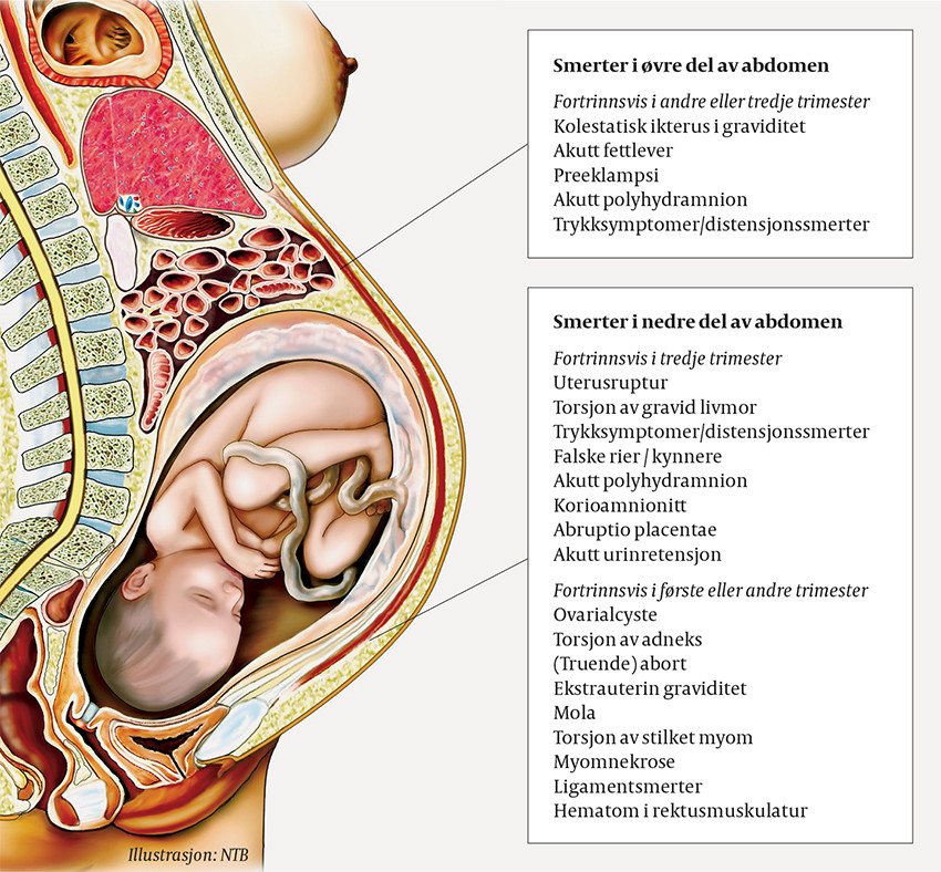 Figur 1 Illustrasjon av gynekologiske overveielser ved akutt abdomen i svangerskap. Risikovurdering vil avhenge av&hellip;