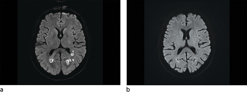 Figur 1 Diffusjonsvektet sekvens a) F&oslash;r behandling: diffusjonsrestriksjon i veggene av lesjonene. b) Etter behandling:&hellip;