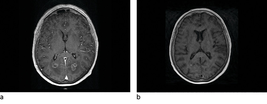 Figur 3 Aksial T1-sekvens med intraven&oslash;s kontrast. a) F&oslash;r behandling: tynn periferisk kontrastoppladning i lesjonene. b)&hellip;