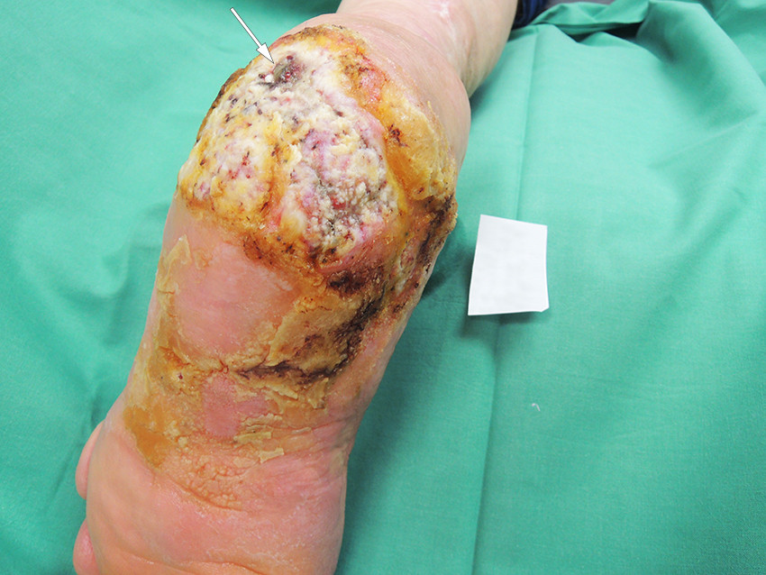 Figur 2 S&aring;rets utseende ved f&oslash;rste konsultasjon. Det m&oslash;rke omr&aring;det &oslash;verst er fistel&aring;pningen mot kalkaneus (markert med pil).