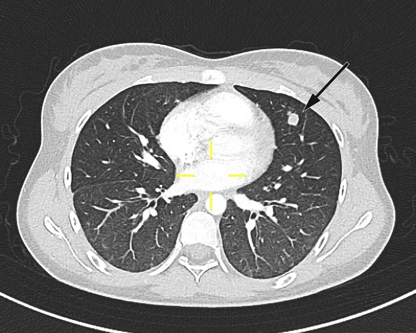 Figur 2 CT-bilde av pasientens lunger tatt p&aring; andre innleggelsesdag. Bildet viser en rundfortetning i venstre overlapp. Den&hellip;