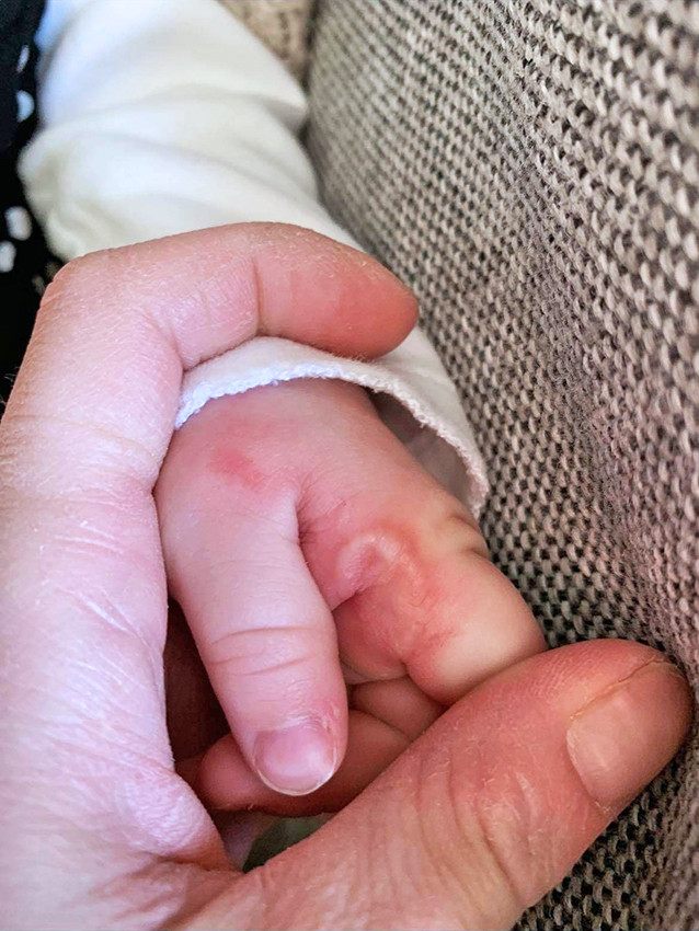 Figur 1 Barnet kom seg raskt etter str&oslash;mst&oslash;tet, men hadde brannskader p&aring; hendene. Foto: Nordlandssykehuset Bod&oslash;