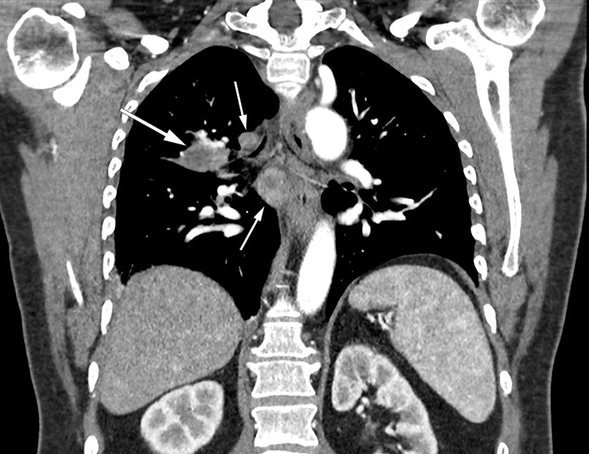 Figure 1 Coronal CT thorax with contrast in a patient with pulmonary tularaemia showing extensive lymphadenopathy (small&hellip;