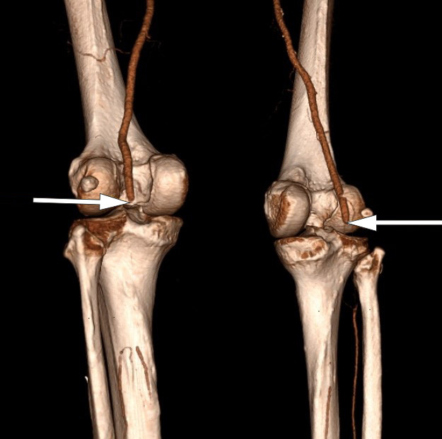 Figure 1 CT angiography shows complete bilateral occlusion of the popliteal arteries.