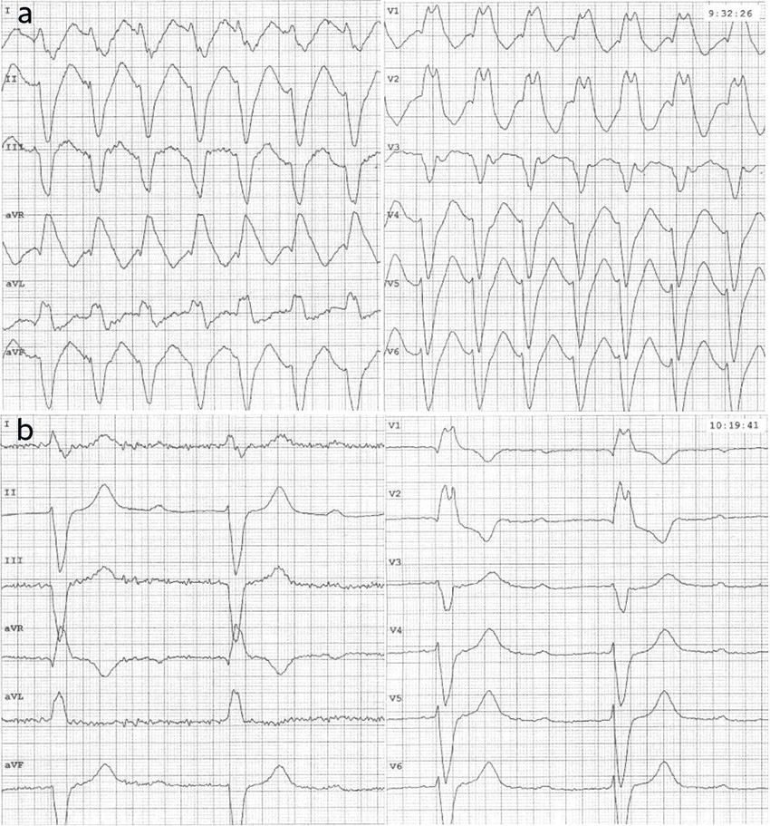 Figur 1 EKG tatt med 50 minutters mellomrom som viser pasientens fluktuerende hjerterytme. Papirhastighet 50 mm/s&hellip;