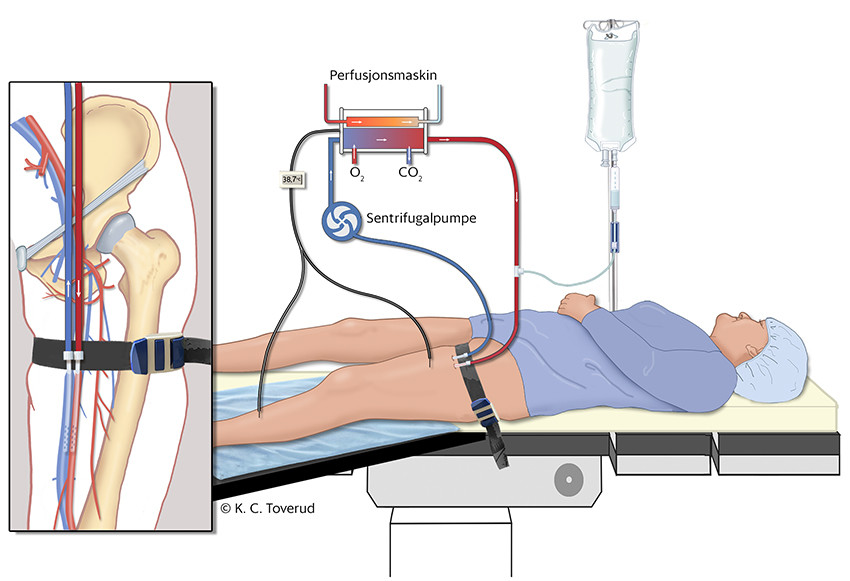 Figur 1 Skjematisk illustrasjon av isolert ekstremitetsperfusjon. Det er lagt kateter i arterie og vene til ekstremiteten&hellip;