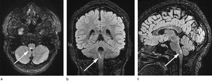 Figure 1 Representative MRI images of lesion in the area postrema: T2-FLAIR in axial (a) coronal (b) and sagittal (c) planes.