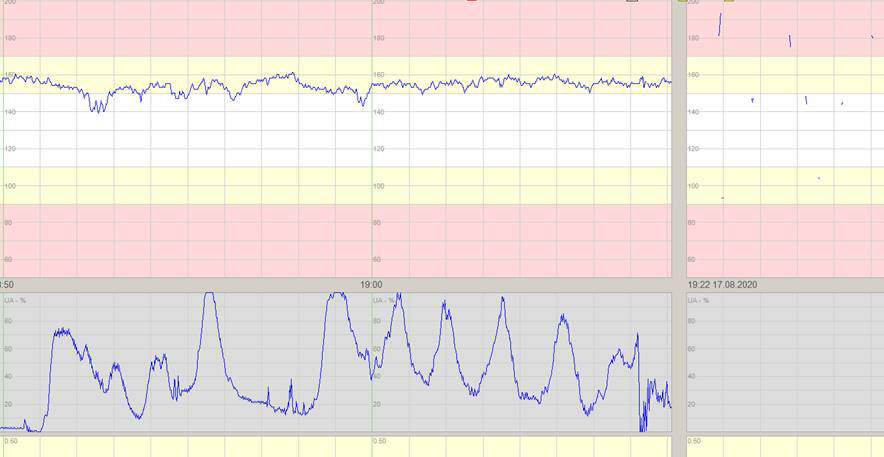 Figure 1 Cardiotocography (CTG) shows the fetal heart rate (upper trace), which is above the reference range (white field)&hellip;