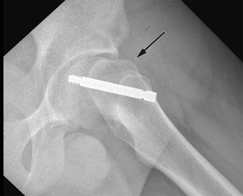 Figur 5 Venstresidig epifysiolysis capitis femoris prim&aelig;rt behandlet med in situ-fiksasjon ett &aring;r tidligere. Klinisk og&hellip;