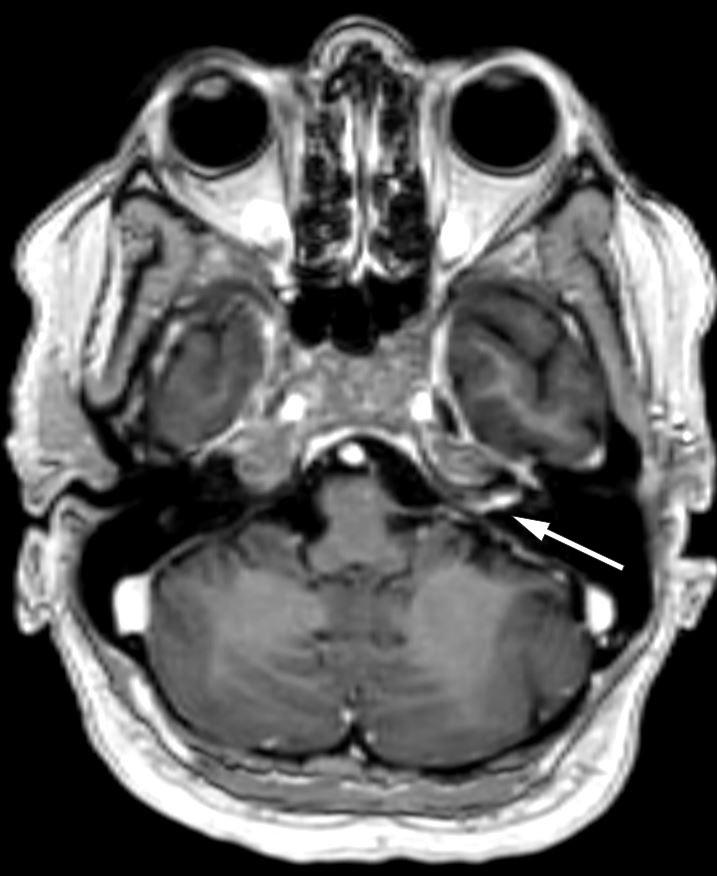 Figur 2 Aksialt MR-bilde av hodet (T1-vekting med intraven&oslash;s kontrast) viser &oslash;kt kontrastoppladning i venstre indre &oslash;regang&hellip;