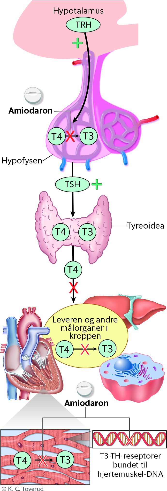 Figur 1 Figuren viser hvordan amiodaron (og dets metabolitter) griper inn i omsetningen av tyreoideahormoner p&aring; flere niv&aring;er&hellip;