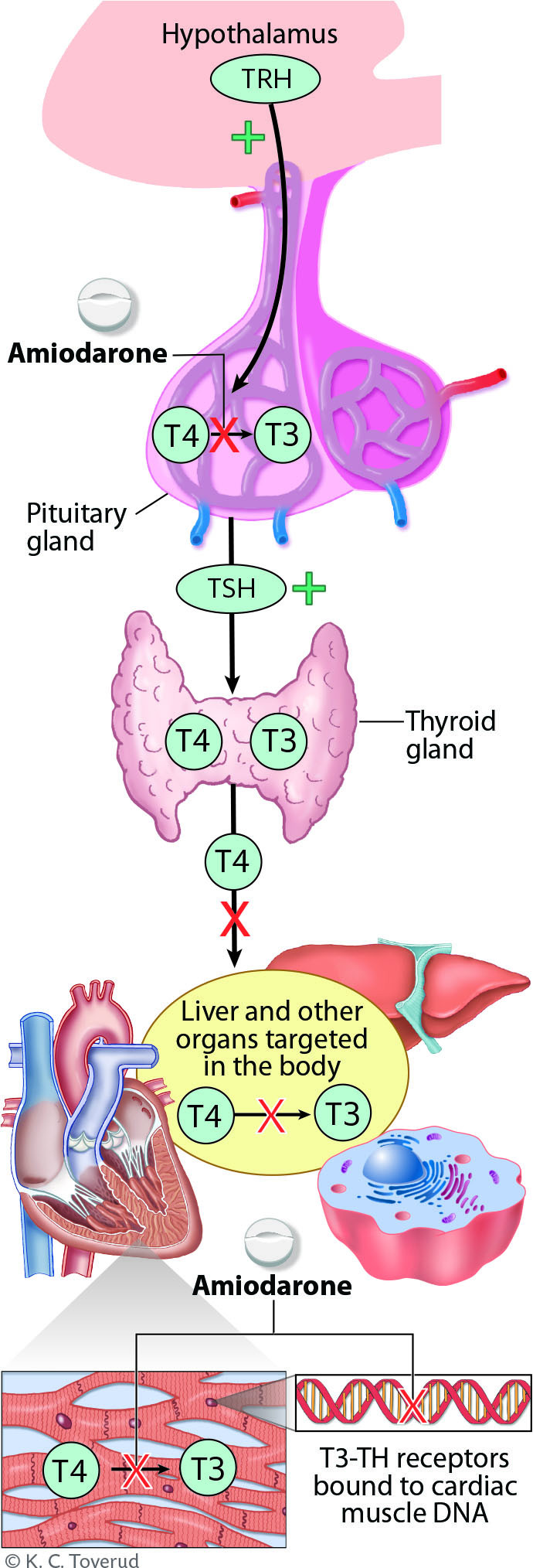 Figure 1 The figure shows how the action of amiodarone (and its metabolites) affects the metabolism of thyroid hormones at&hellip;