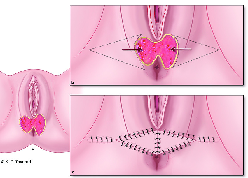 Figure 2 Illustration of how a wound defect in the perineum can be covered with bilateral advancement flaps. The wound&hellip;