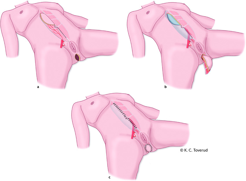 Figur 3 S&aring;rdefekt etter reseksjon av endetarm og anus som er rekonstruert med vertikal rectus abdominis myokutan lapp (VRAM&hellip;