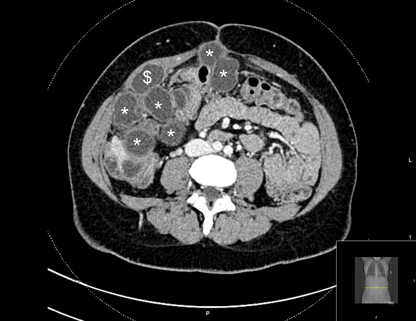 Figur 1 CT abdomen med kontrast, aksialplan. Man ser multiple cyster i fascie og intraabdominalt (*) samt cyste i m. rectus&hellip;