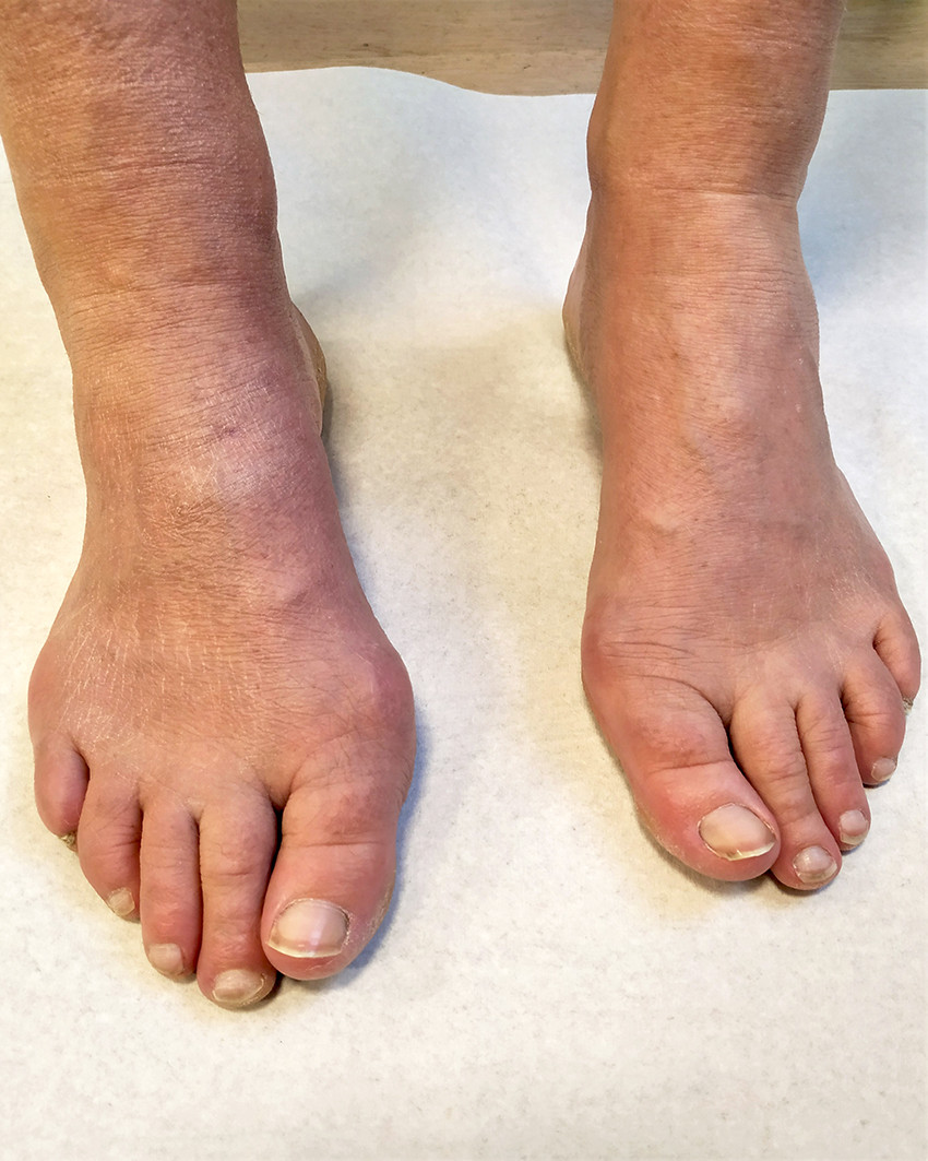 Figure 1 Acrodermatitis chronica atrophicans on the dorsal right foot. There is a clear difference in size around the ankle&hellip;