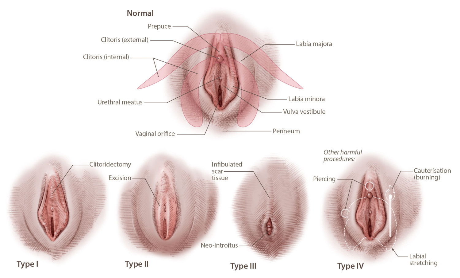 Figure 1 Types of FGC, based on WHO definitions. (2). a) Type I: Full or partial removal of the external part of the&hellip;