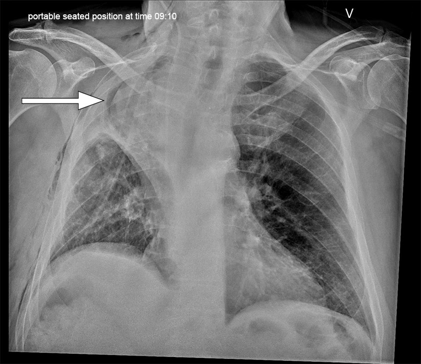 Figure 1 Erect anteroposterior CXR on postoperative day 1 following primary surgery. The image demonstrates opacities in the&hellip;