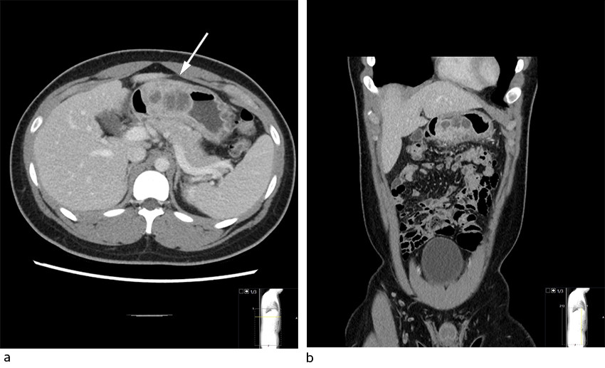 Figur 1 Transversale (a) og koronale (b) CT-snitt gjennom abdomen med intraven&oslash;s kontrastv&aelig;ske og negativ peroral&hellip;
