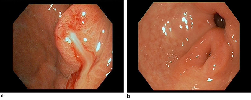 Figur 2 Gastroskopi. a) Man ser en stor submuk&oslash;s tumor i antrum med flere sm&aring; erosjoner og diffus r&oslash;dme, der puss t&oslash;mmes&hellip;