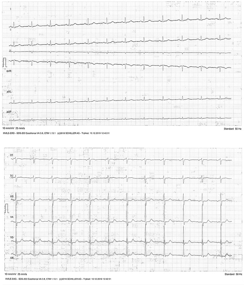 Figur 1 EKG tatt i hvile viser sinusrytme og normal elektrisk akse i alle de 12 avledningene.