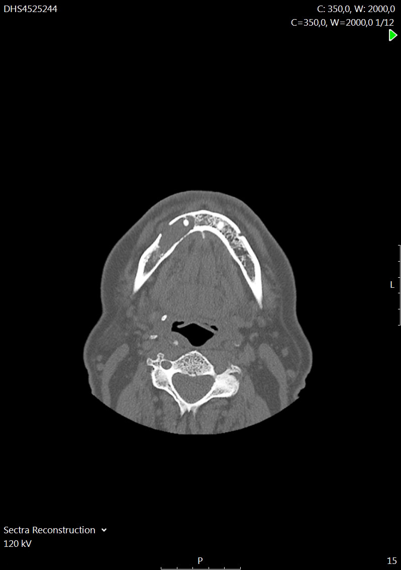 Figur 2 CT ansiktsskjelett. Aksialplan. Lytisk prosess i h&oslash;yre mandibula med bl&oslash;tdelskomponent som protruderer gjennom en&hellip;