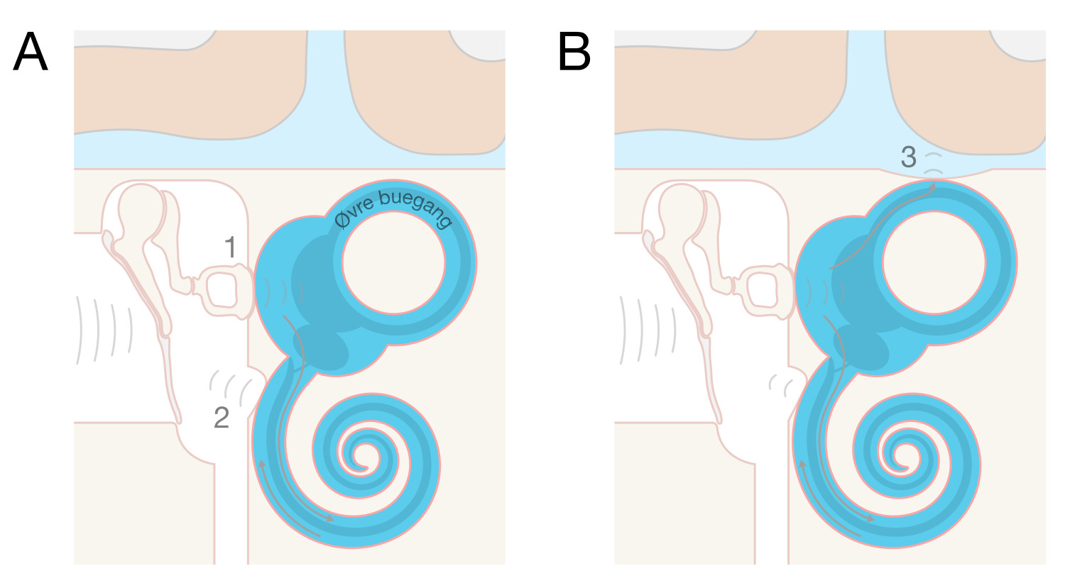 Figur 1 Patofysiologi ved buegangsdehiscens. A) Normal anatomi: To ettergivelige omr&aring;der i labyrinten &ndash; det ovale vinduet&hellip;
