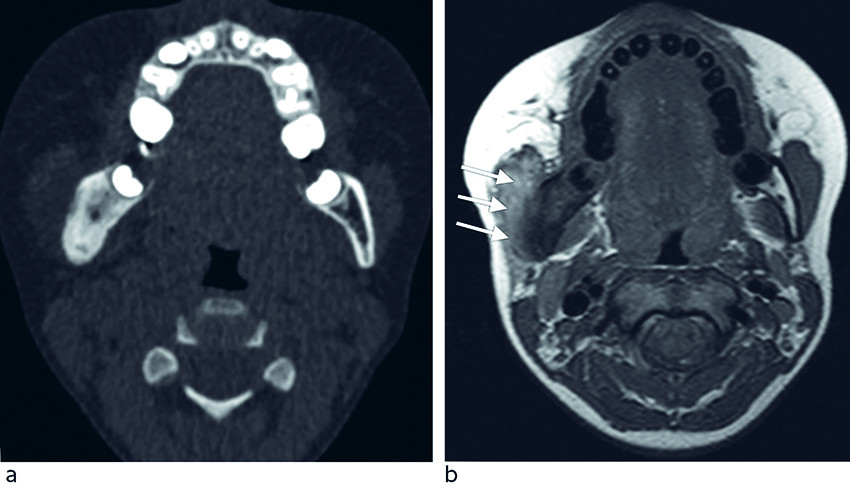 Figur 3 Pasient 3. a) CT (aksialt snitt) viser sklerotisering av benvev i ramus mandibula p&aring; h&oslash;yre side og utvisket kortikal&hellip;