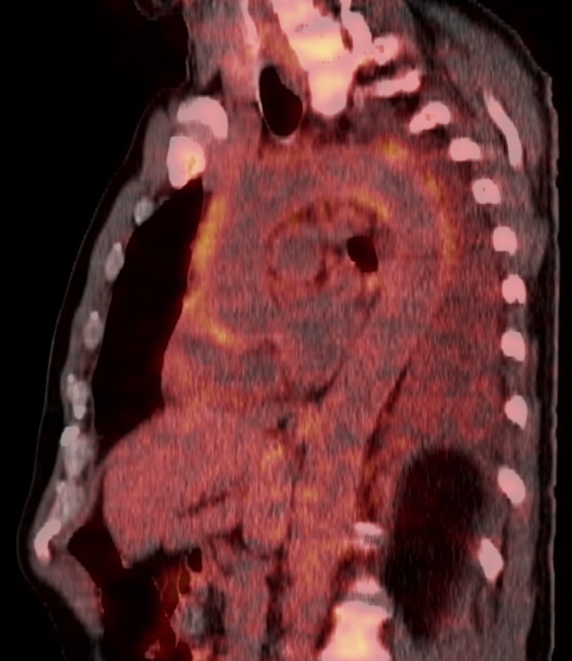 Figure 1 PET scan with 18F-fluorodeoxyglucose combined with CT (18F-FDG-PET-CT) shows the thoracic aorta (sagittal section)&hellip;