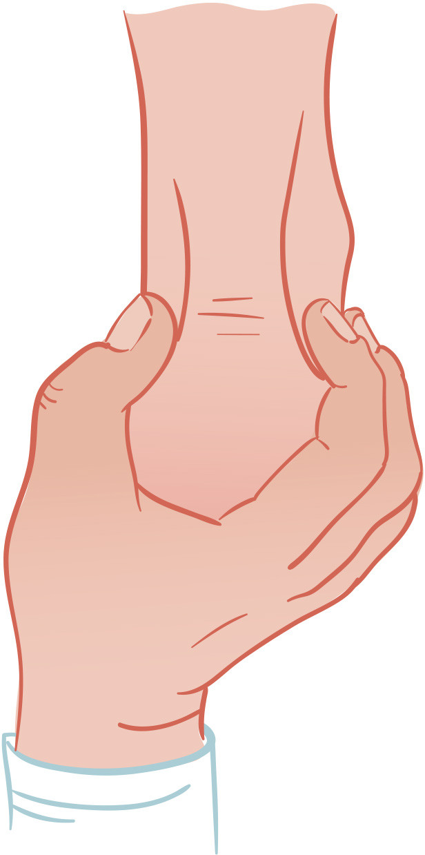 Figur 1 Calcaneusklemmetesten. Illustrasjon: Illumedic