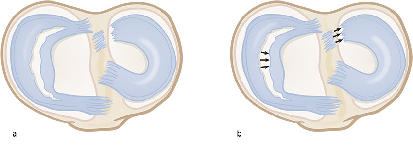 Figure 2 a) Bucket-handle tear in the medial meniscus (left) and posterior root tear in the lateral meniscus (right). b) The&hellip;