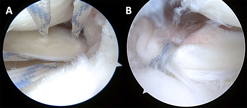 Figure 4 Arthroscopy. a) Medial root tear with sutures in the posterior horn of the meniscus. b) Sutures pulled down into&hellip;