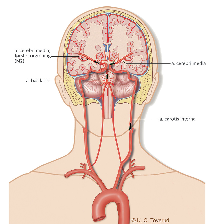 Figur 1 Okklusjoner i kretsl&oslash;p tilgjengelig for trombektomi.