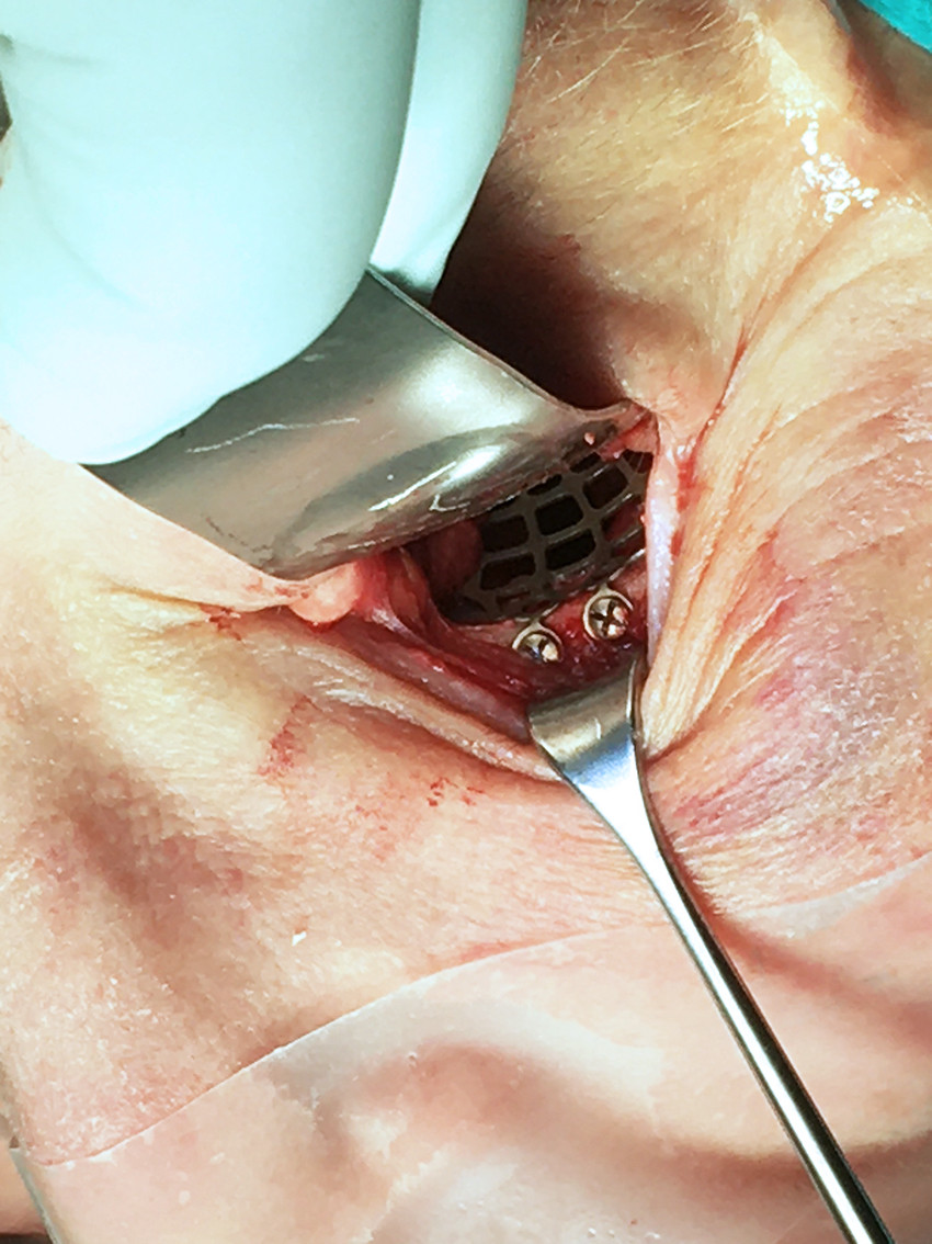 Figur 4 Peroperativt foto av venstresidig gulvfraktur rekonstruert med pasientspesifikk rekonstruksjonsplate i titan.