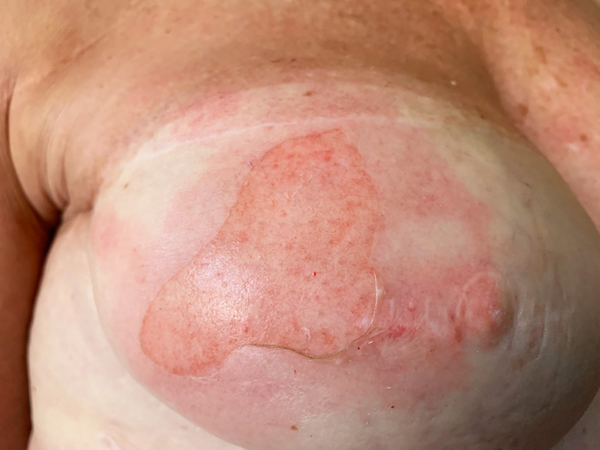 Figur 1 Bilde tatt av pasienten selv dagen etter soling viser skade og bortfall av det ytre hudlaget (epidermis) og et&hellip;