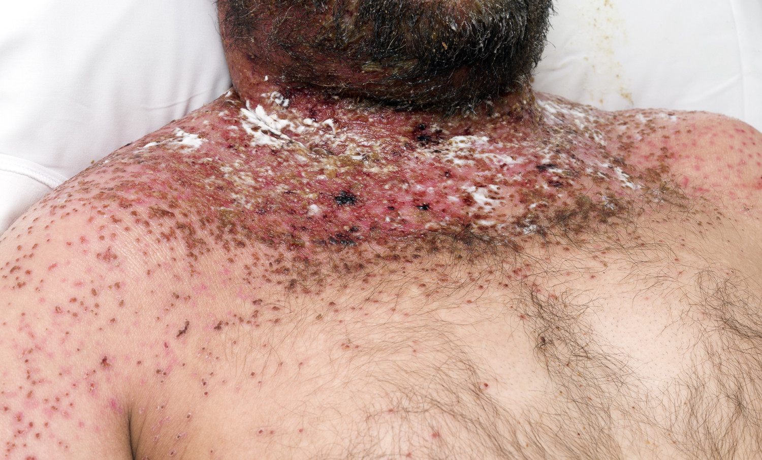 Figur 1 Erosive flater og v&aelig;skende dermatitt i ansikt, nakke og hals, med spredte krustebelagte erosjoner i nakken og p&aring;&hellip;