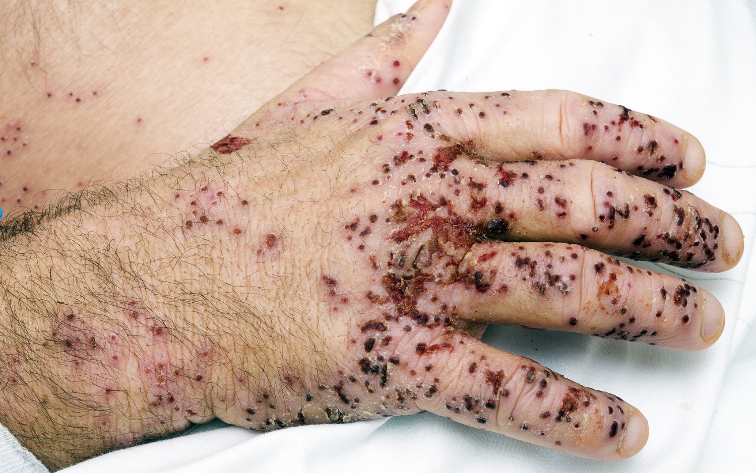 Figure 2 Dorsal hand with multiple crusted erosions and fissures.