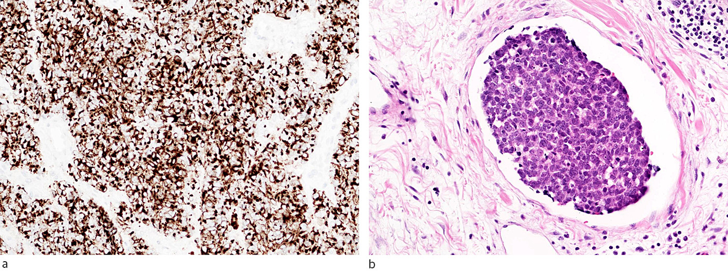 Figure 2 a) Immunohistochemical examination of Merkel cell carcinoma with the marker CK20 (cytokeratin 20), which often&hellip;