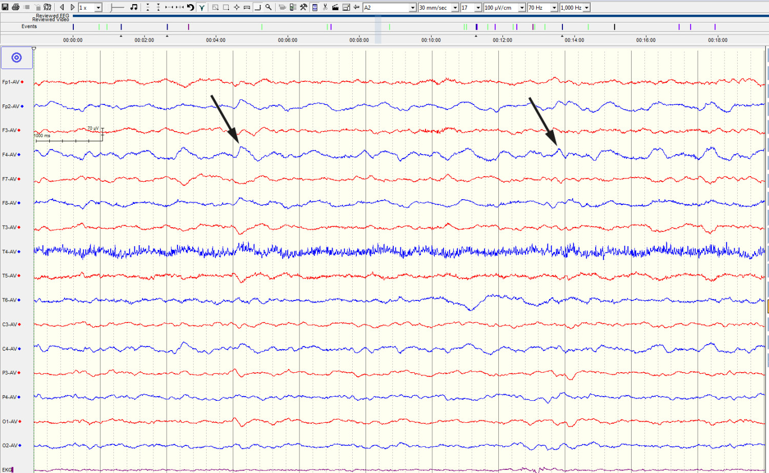 Figure 1 The patient's EEG showed slowing of background activity and irregular delta waves over the right hemisphere,&hellip;