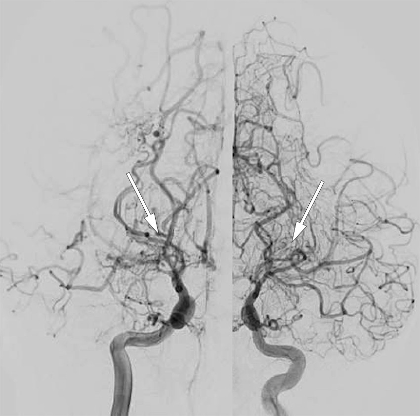 Figur 1 Et barn i tidlig skolealder opplevde i ett &aring;rs tid nattlige anfall med hodepine, kvalme og oppkast, senere&hellip;