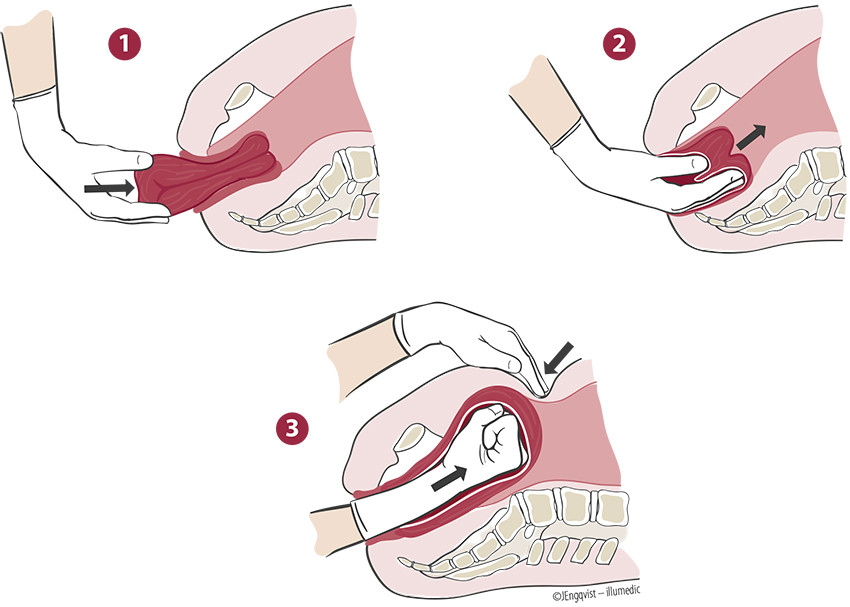 Figur 1 Skjematisk fremstilling av Johnsons man&oslash;ver.